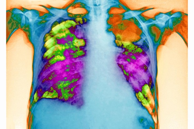 Entre 400 et 600.000 personnes souffrent de pneumopathie chronique en Belgique