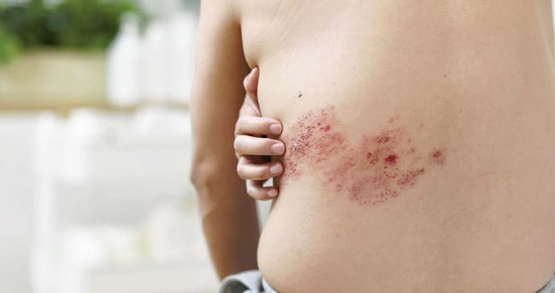 Vacciner pour prévenir les névralgies du zona 